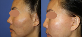 cheek-reduction-p4-4