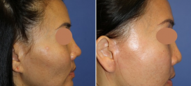 cheek-reduction-p4-5
