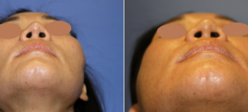 cheek-reduction-p4-6