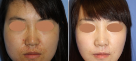 cheek-reduction-p5-1