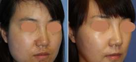cheek-reduction-p5-2