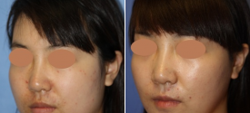 cheek-reduction-p5-3