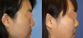 cheek-reduction-p5-4