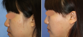 cheek-reduction-p5-5