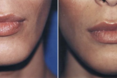 03_genioplasty