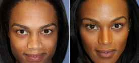 chin-reduction-genioplasty-p1-1