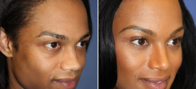 chin-reduction-genioplasty-p1-2