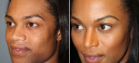 chin-reduction-genioplasty-p1-3