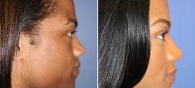 chin-reduction-genioplasty-p1-4