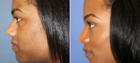 chin-reduction-genioplasty-p1-5