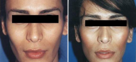 chin-reduction-genioplasty-p2-1