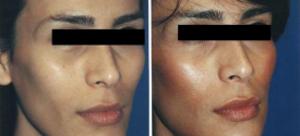 chin-reduction-genioplasty-p2-2
