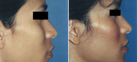 chin-reduction-genioplasty-p2-3
