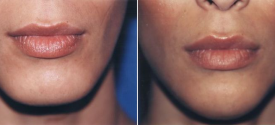 chin-reduction-genioplasty-p2-4