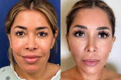 03_facelift-1