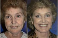 07_facelift