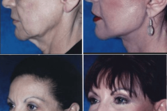 10_facelift