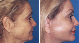 facelift-p12-3