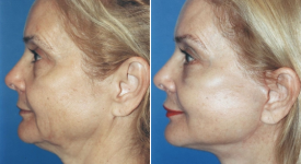 facelift-p12-4