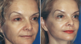 facelift-p12-5