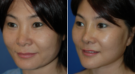 facelift-p13-2