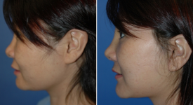 facelift-p13-3
