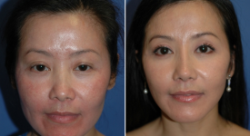 facelift-p15-1