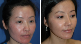 facelift-p15-2