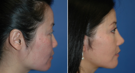 facelift-p15-3