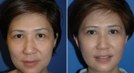 facelift-p16-1