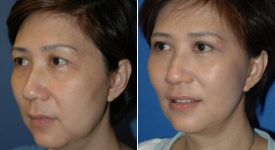 facelift-p16-2