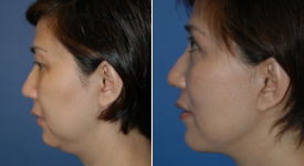 facelift-p16-3