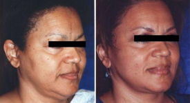 facelift-p2-1