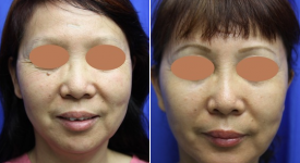 facelift-p20-1