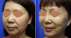 facelift-p20-2