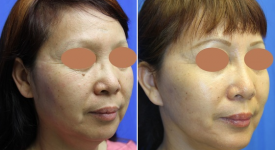 facelift-p20-3
