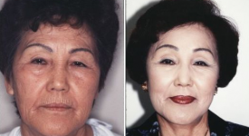 facelift-p6
