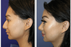 01_browbone_reduction_reconstruction