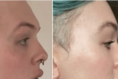 03_browbone_reduction_n_reconstruction