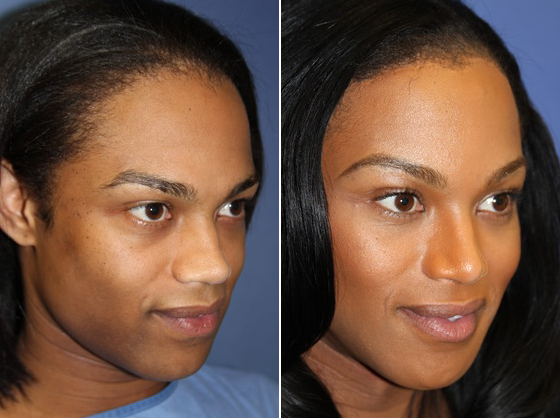 Forehead And Brow Lift Photos