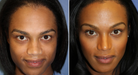 forehead-brow-lifts-p1-1
