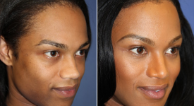 forehead-brow-lifts-p1-2