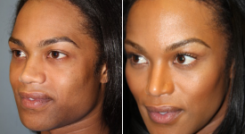 forehead-brow-lifts-p1-3