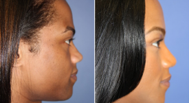 forehead-brow-lifts-p1-4