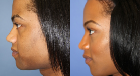 forehead-brow-lifts-p1-5