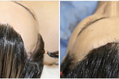 01_hairline_advancement