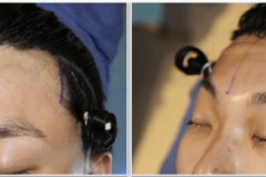 02_hairline_advancement
