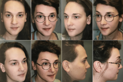 03_hairline_advancement