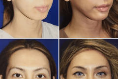 04_hairline_advancement