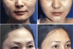 04_jaw_reduction